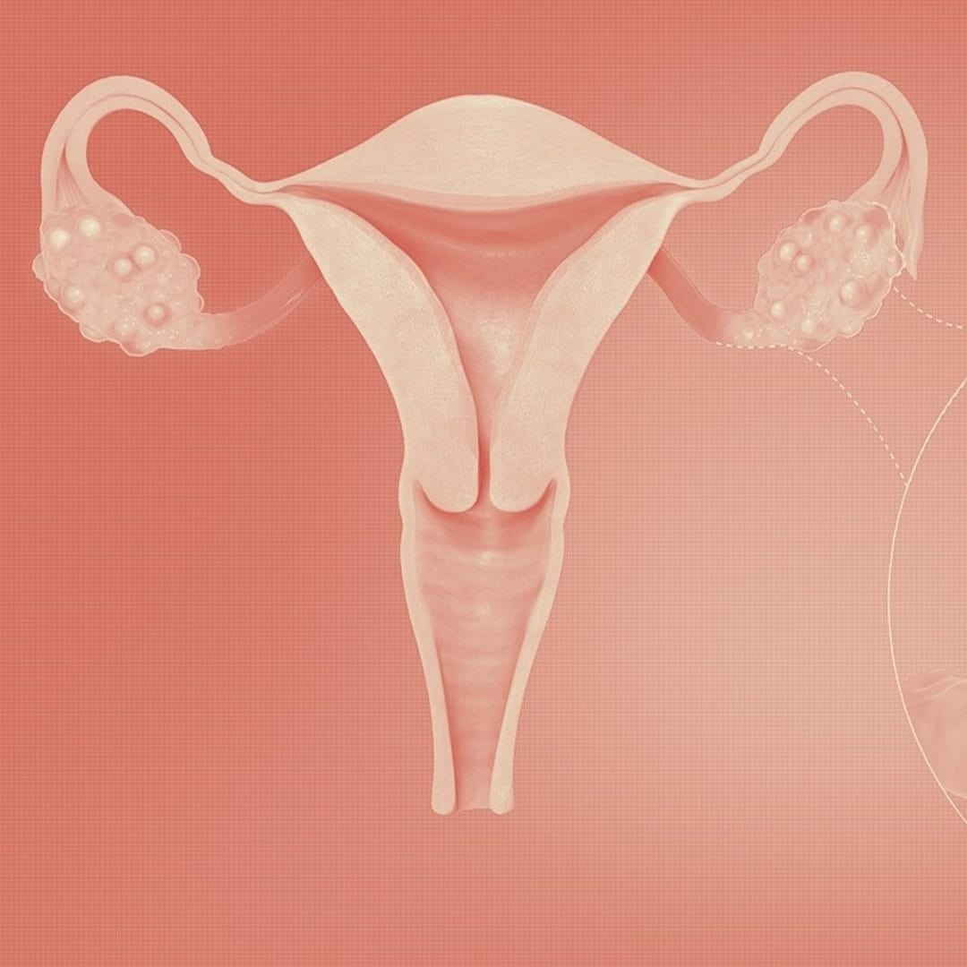 PCOS and Acne