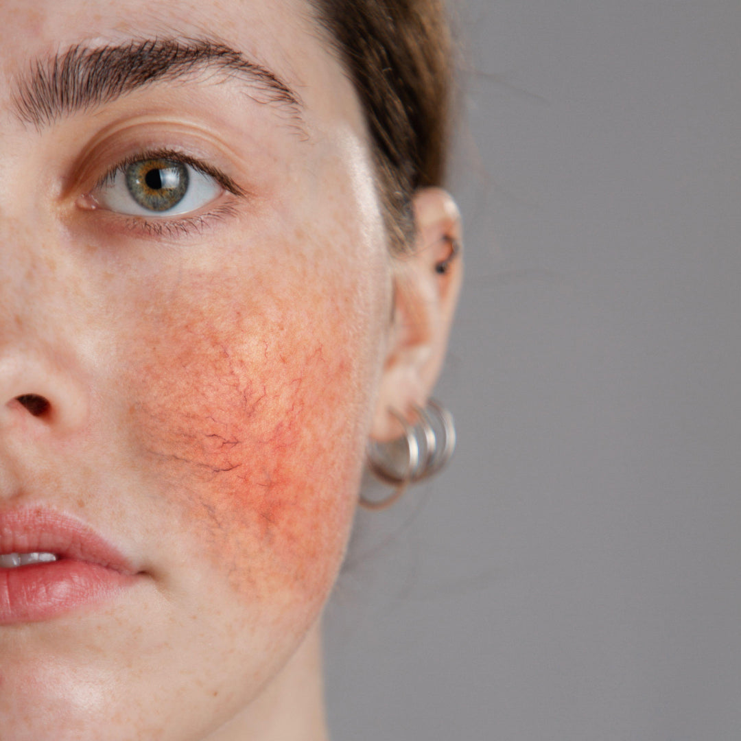Acne vs. Rosacea Uk version
