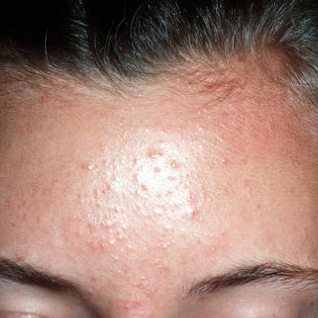 Fungal Acne Uk version