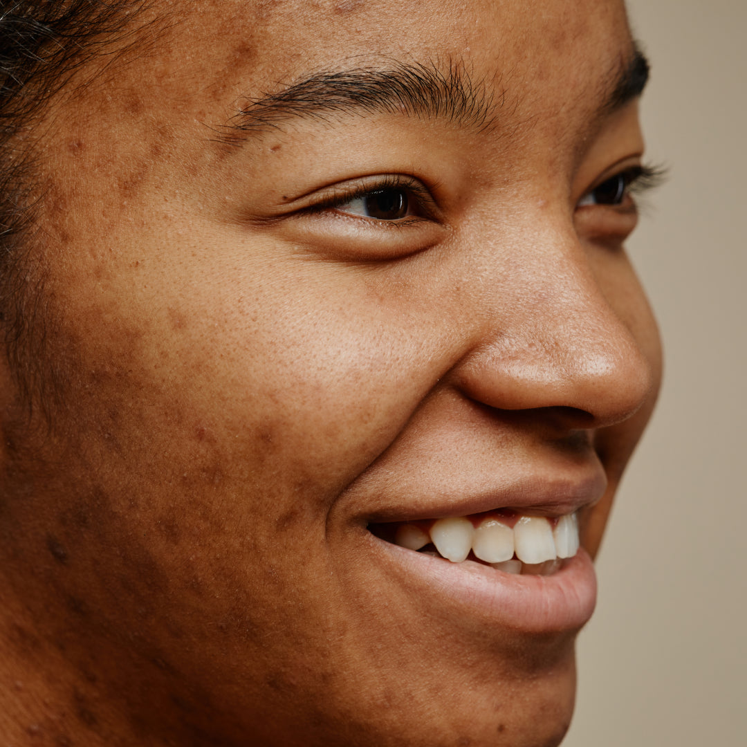Types Of Acne Uk version