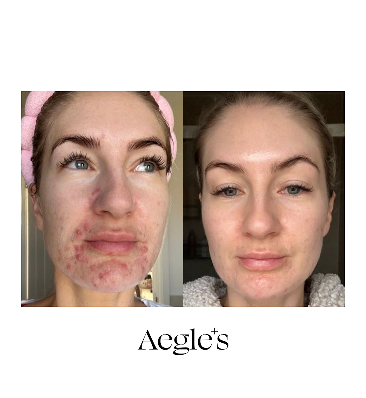 Clear Skin Complex